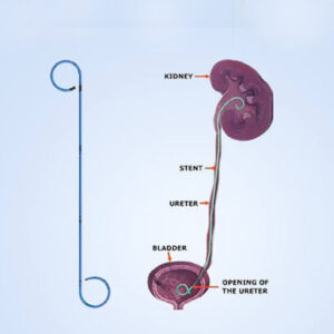 Double J Ureteral Stents