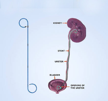 Double-J-Ureteral-Stents